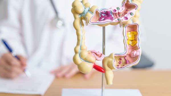 Darmkrebs ist heilbar