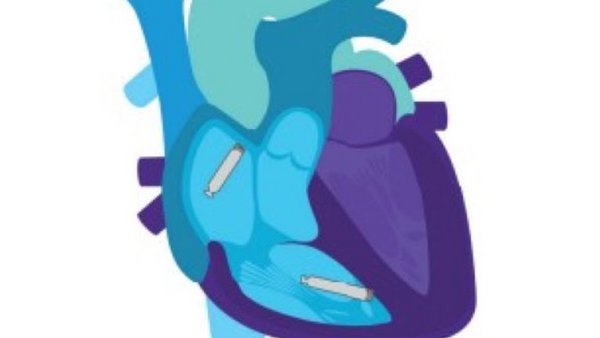 AMEOS Klinikum Schönebeck setzt Meilenstein in Herzmedizin