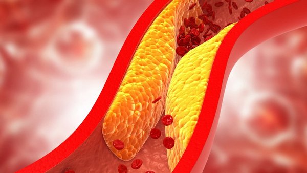 Benötige ich einen Cholesterin-Senker oder schadet er mir?